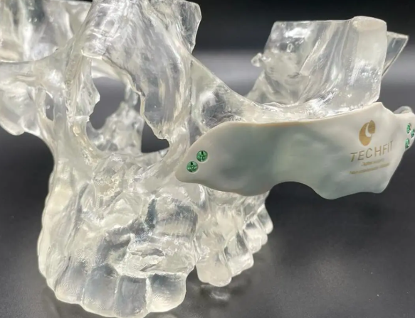 如何用SLA医疗3D打印技术实现骨科植入物个性化定制